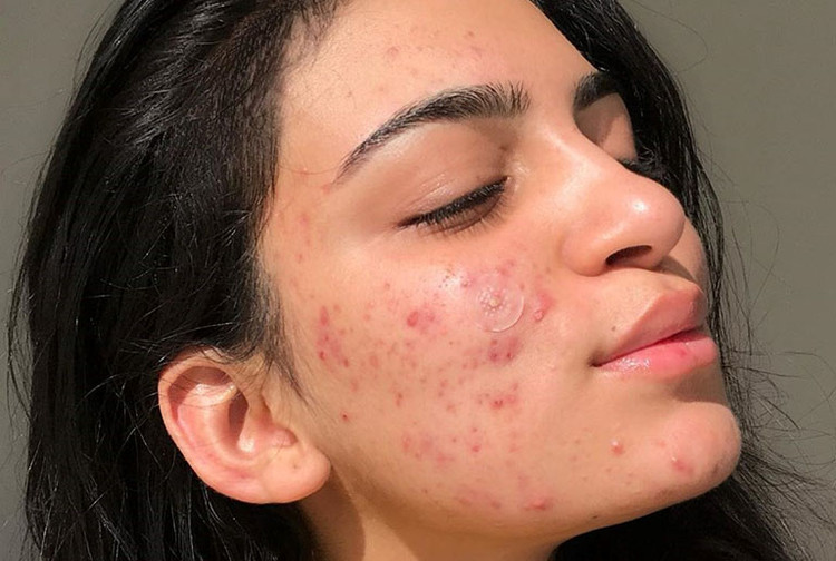 Bước vào tuổi dậy thì, làn da bắt đầu thay đổi ở cả nam và nữ. Giai đoạn này cần chăm sóc cẩn thận để da không rơi vào tình trạng tiết quá nhiều dầu nhờn, mọc nhiều trứng cá, mụn mủ… Ảnh minh họa