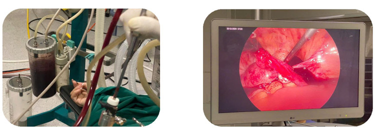 Trong phẫu thuật, các bác sĩ đã cầm máu, cắt khối thai ngoài tử cung vỡ, hút ra rất nhiều máu trong ổ bụng. Đồng thời bệnh nhân được truyền 3 đơn vị máu và 3 đơn vị huyết tương. Ảnh BVCC