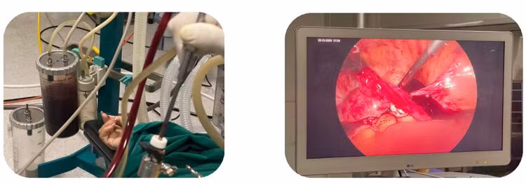 Trong phẫu thuật, các bác sĩ đã cầm máu, cắt khối thai ngoài tử cung vỡ, hút ra rất nhiều máu trong ổ bụng. Đồng thời bệnh nhân được truyền 3 đơn vị máu và 3 đơn vị huyết tương. Ảnh BVCC