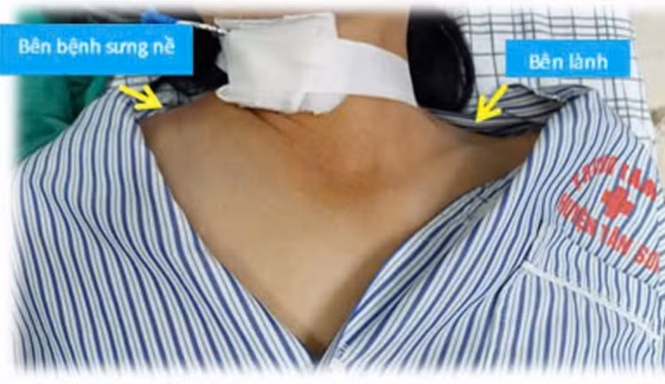 Tổn thương bên tiêm thuốc của người bệnh. Ảnh: BVCC