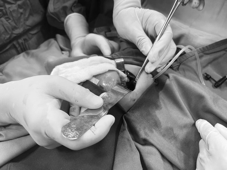 Các bác sĩ phẫu thuật thoát vị hoành cho trẻ sơ sinh. Ảnh BVCC Các bác sĩ phẫu thuật thoát vị hoành cho trẻ sơ sinh. Ảnh BVCC