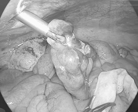 Hình ảnh nội soi cho thấy ruột thừa viêm căng mủ. Ảnh BVCC