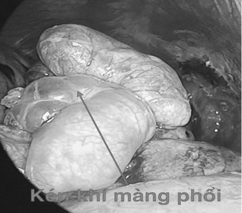 Hình ảnh kén khí màng phổi của bệnh nhân. Ảnh BVCC