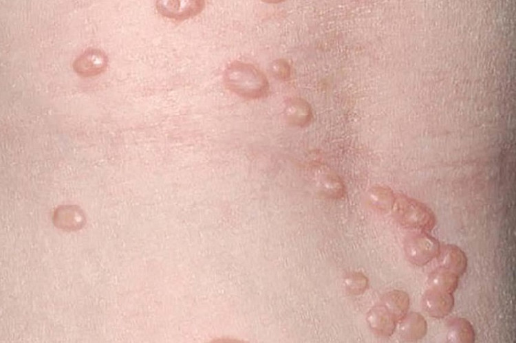 Các nốt sẩn màu trắng đục xuất hiện trên da của bệnh nhân. Ảnh minh họa