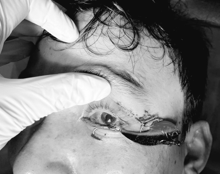 Lưỡi câu găm trong mi mắt người đàn ông. Ảnh BVCC