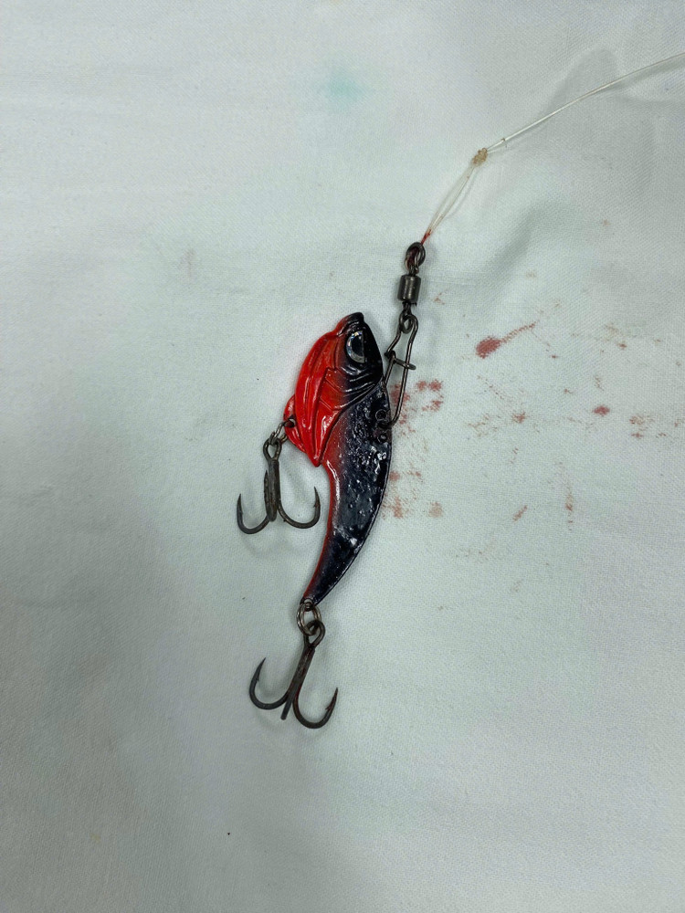 Lưỡi câu móc vào mắt bệnh nhân được bác sĩ mổ lấy ra. Ảnh BVCC