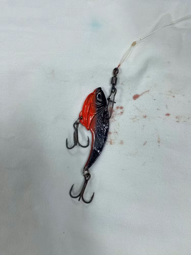 Lưỡi câu móc vào mắt bệnh nhân được bác sĩ mổ lấy ra. Ảnh BVCC Lưỡi câu móc vào mắt bệnh nhân được bác sĩ mổ lấy ra. Ảnh BVCC