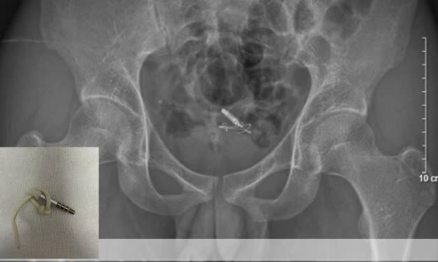 Kết quả chụp X-quang và siêu âm cho thấy dị vật nằm trọn trong bàng quang. Ảnh BVCC