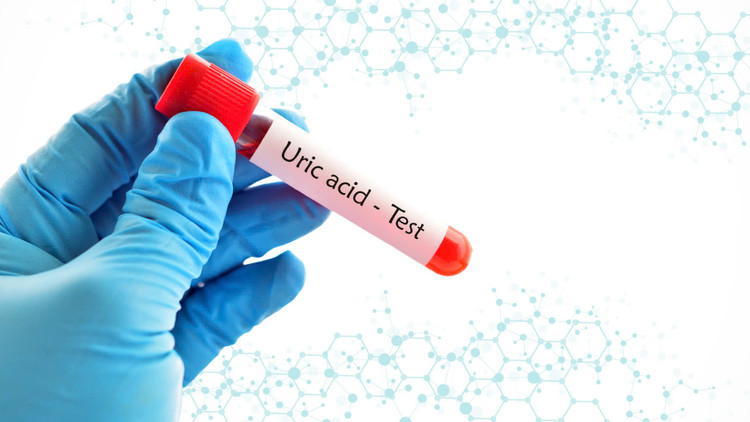 Nồng độ axit uric trong cơ thể tăng lên có thể dẫn đến các vấn đề sức khỏe như ảnh hưởng đến thận, làm tăng nguy cơ tạo sỏi, bệnh gút..... Ảnh minh họa