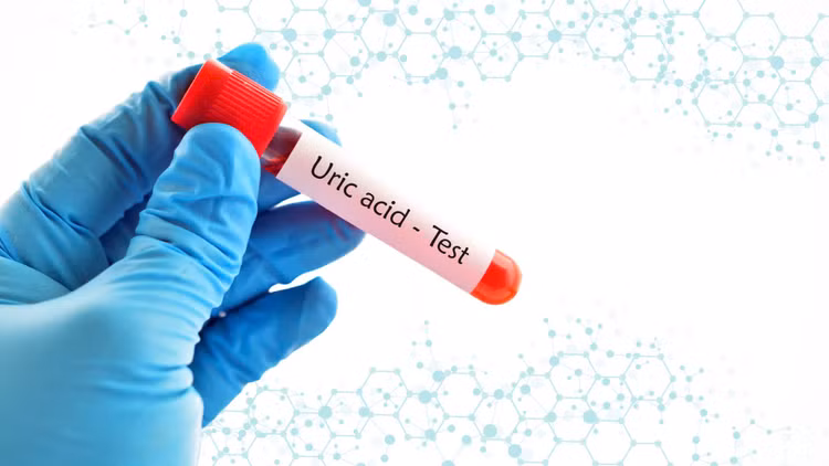 Nồng độ axit uric trong cơ thể tăng lên có thể dẫn đến các vấn đề sức khỏe như ảnh hưởng đến thận, làm tăng nguy cơ tạo sỏi, bệnh gút..... Ảnh minh họa