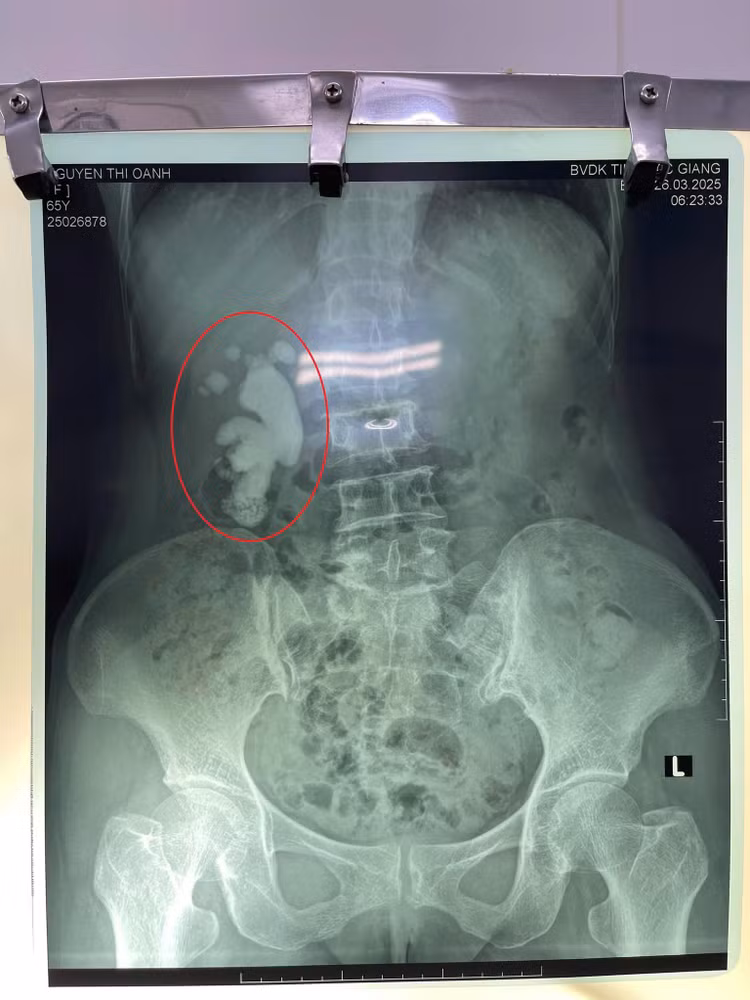 Kết quả chụp CT cho thấy hình ảnh sỏi san hô thận phải. Ảnh BVCC
