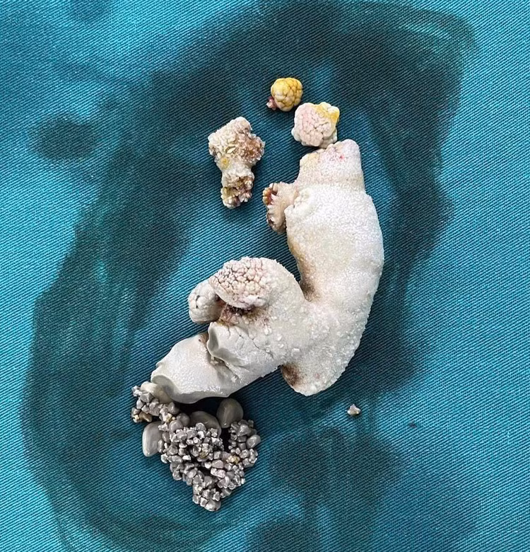 Bác sĩ loại bỏ sỏi trong lòng bể thận bệnh nhân. Ảnh BVCC