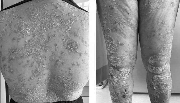 Bệnh vảy nến Bệnh vảy nến