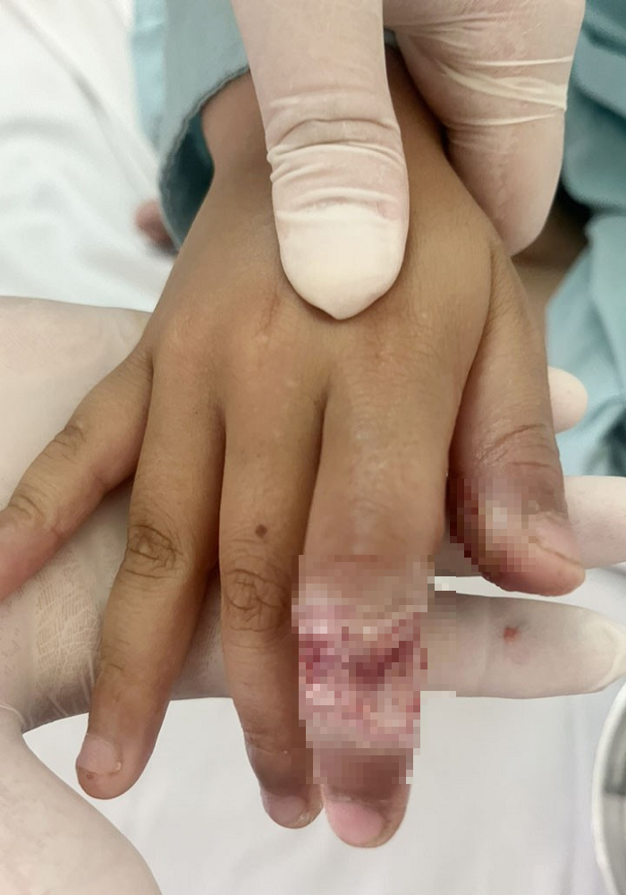 Bé trai 7 tuổi bị bỏng tay khi rút điện thoại đang sạc. Ảnh BVCC