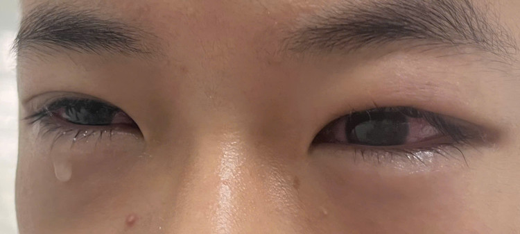 Trẻ bị bỏng giác mạc do gội đầu bằng nước hạt na. Ảnh BVCC