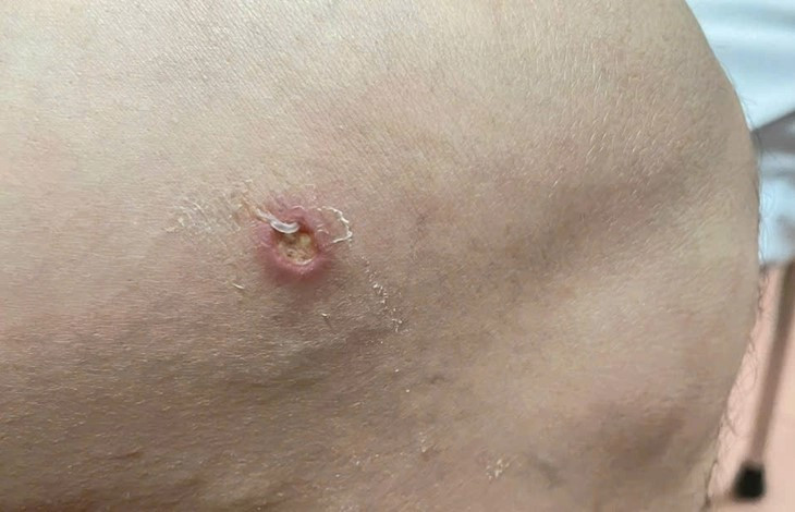 Phat hien them ca benh giun rong thu 26 tai Phu Tho