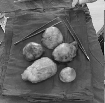 Các bác sĩ phẫu thuật cắt bỏ đa u xơ tử cung, u nang buồng trứng kích thước lớn cho bệnh nhân. Ảnh TTYT Thanh Ba (Phú Thọ)