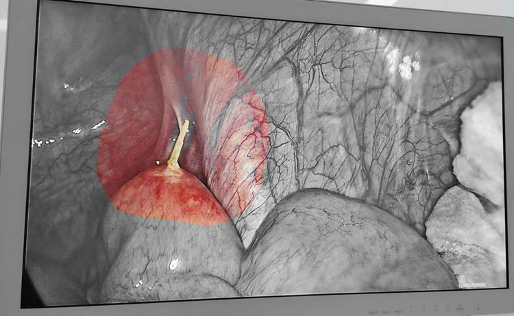 Bệnh nhân bị tổn thương đường tiêu hóa do thói quen ngậm tăm tre. Ảnh BVCC