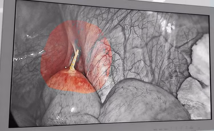 Bệnh nhân bị tổn thương đường tiêu hóa do thói quen ngậm tăm tre. Ảnh BVCC