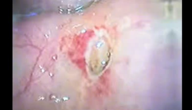 Hình ảnh siêu âm phát hiện bệnh nhân bị thủng tạng rỗng do viêm loét dạ dày. Ảnh TTYT huyện Tân Sơn (Phú Thọ)