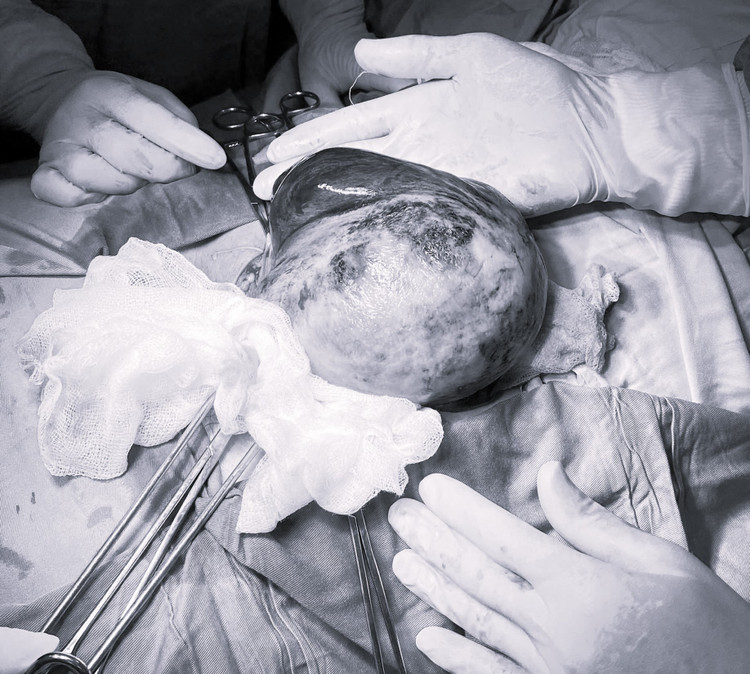 Tử cung bệnh nhân Đ.T.Q.A. có nhiều ổ nhồi huyết tím bầm. Ảnh BVCC