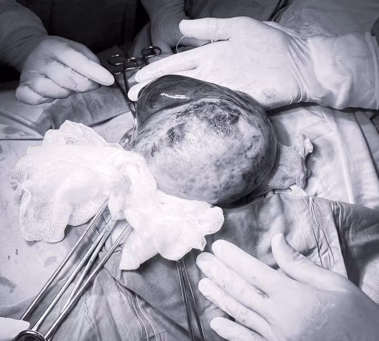 Tử cung bệnh nhân Đ.T.Q.A. có nhiều ổ nhồi huyết tím bầm. Ảnh BVCC