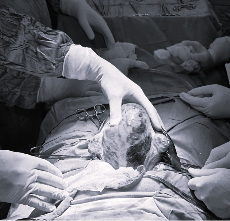 Tử cung bệnh nhân Đ.T.Q.A. có nhiều ổ nhồi huyết tím bầm. Ảnh BVCC