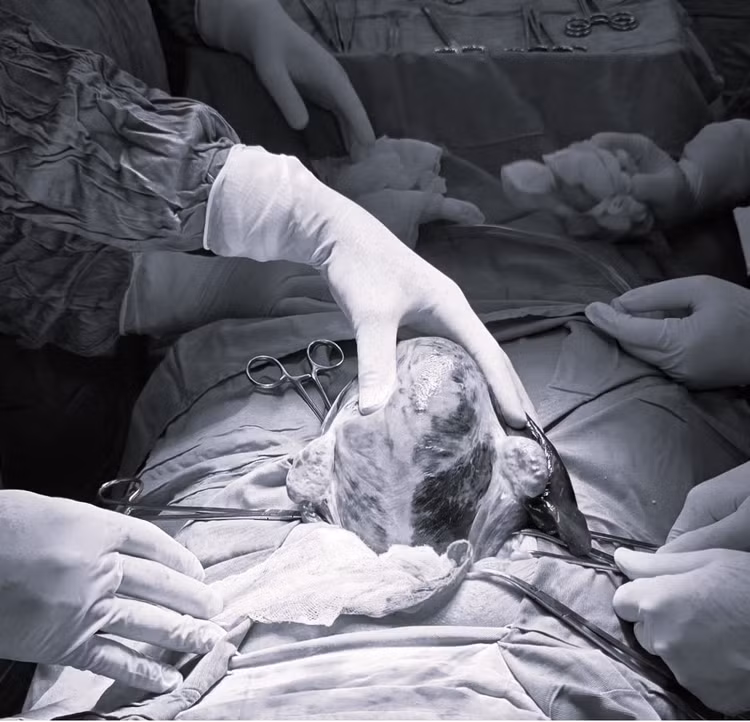 Tử cung bệnh nhân Đ.T.Q.A. có nhiều ổ nhồi huyết tím bầm. Ảnh BVCC