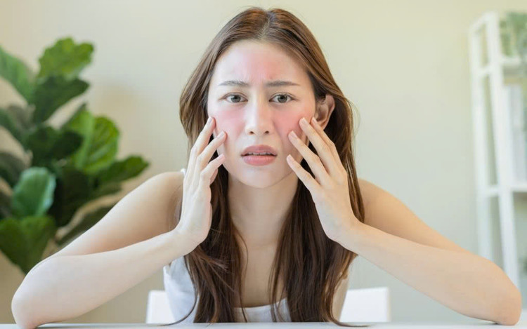 Da bị tổn thương do kích ứng mỹ phẩm. Ảnh Internet Da bị tổn thương do kích ứng mỹ phẩm. Ảnh Internet