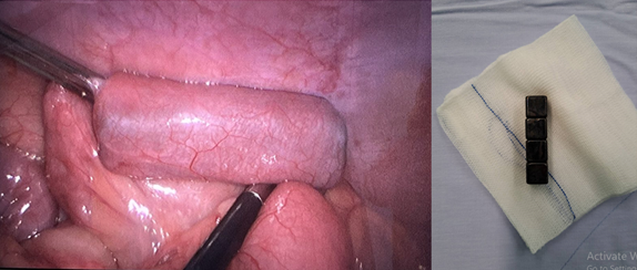 Dị vật nằm trong ruột non được lấy ra, không ghi nhận thủng hay xuất huyết. Ảnh BVCC