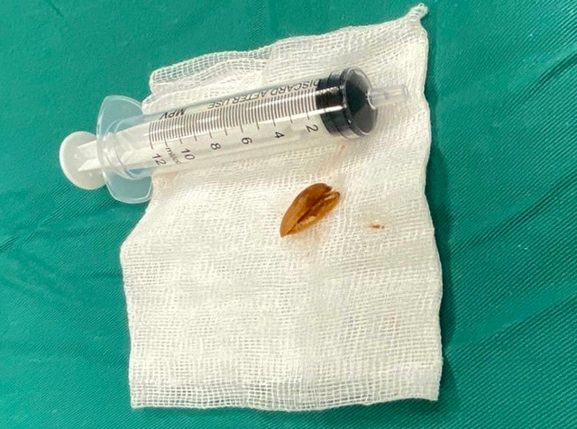 Vỏ hạt hướng dương gây cho bé trai viêm phổi nặng, ho kéo dài. Ảnh suckhoevadoisong