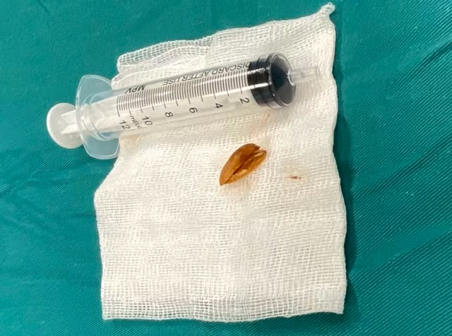 Vỏ hạt hướng dương gây cho bé trai viêm phổi nặng, ho kéo dài. Ảnh suckhoevadoisong