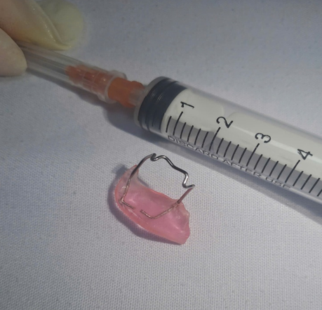 Hình ảnh dị vật là hàm duy trì đã được bác sĩ xử trí kịp thời. Ảnh BVCC