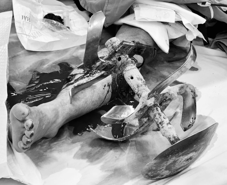 Lưỡi bừa mắc kẹt trong cẳng chân của bệnh nhân. Ảnh: BVCC