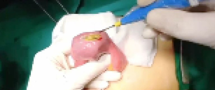 Thói quen ăn uống sai lầm khiến người phụ nữ nhập viện vì tắc ruột nghiêm trọng. Ảnh TTYT huyện Thanh Thủy Thói quen ăn uống sai lầm khiến người phụ nữ nhập viện vì tắc ruột nghiêm trọng. Ảnh TTYT huyện Thanh Thủy