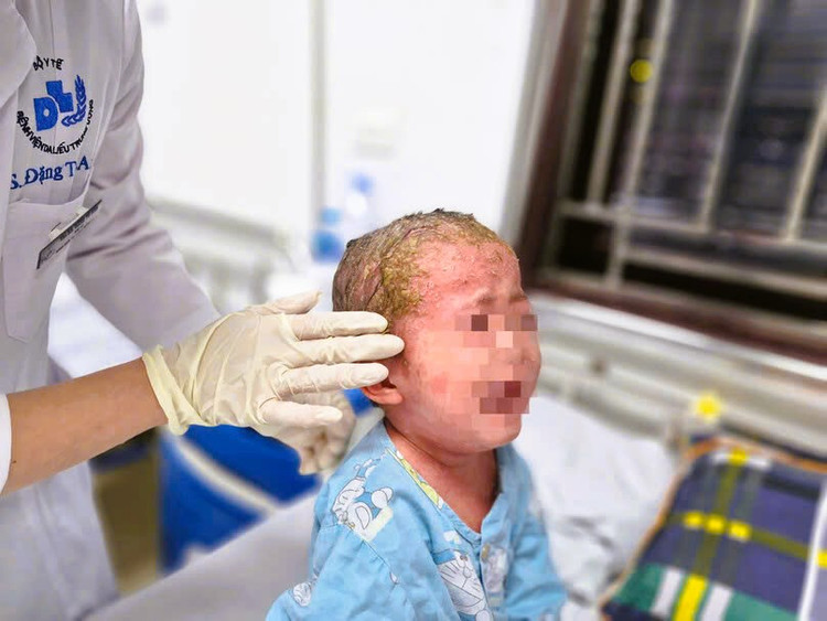 Bé trai mắc bệnh vảy nến không được điều trị sớm dẫn tới bệnh bùng phát nặng. Ảnh BVCC