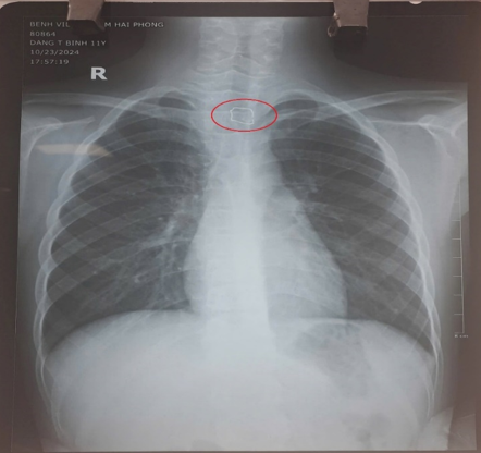 Hình ảnh XQ dị vật trong đường tiêu hoá. Ảnh BVCC