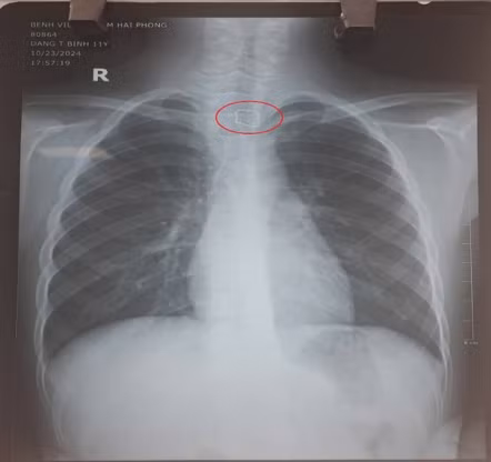 Hình ảnh XQ dị vật trong đường tiêu hoá. Ảnh BVCC