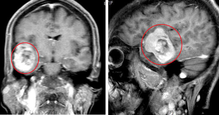Hình ảnh khối u của người bệnh. Ảnh BVCC