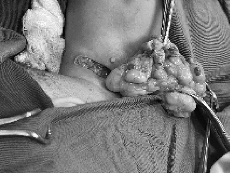 Khối u mỡ khổng lồ được loại bỏ ra khỏi cổ của bệnh nhi sau ca phẫu thuật thành công. Ảnh BVCC