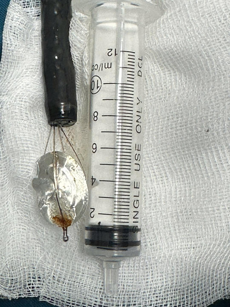 Dị vật nắp lon nước ngọt sau khi được gắp ra khỏi dạ dày bé trai 11 tuổi. Ảnh: BVCC