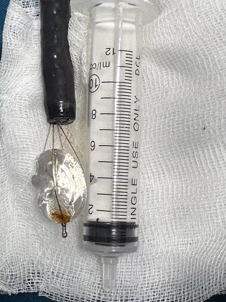 Dị vật nắp lon nước ngọt sau khi được gắp ra khỏi dạ dày bé trai 11 tuổi. Ảnh: BVCC