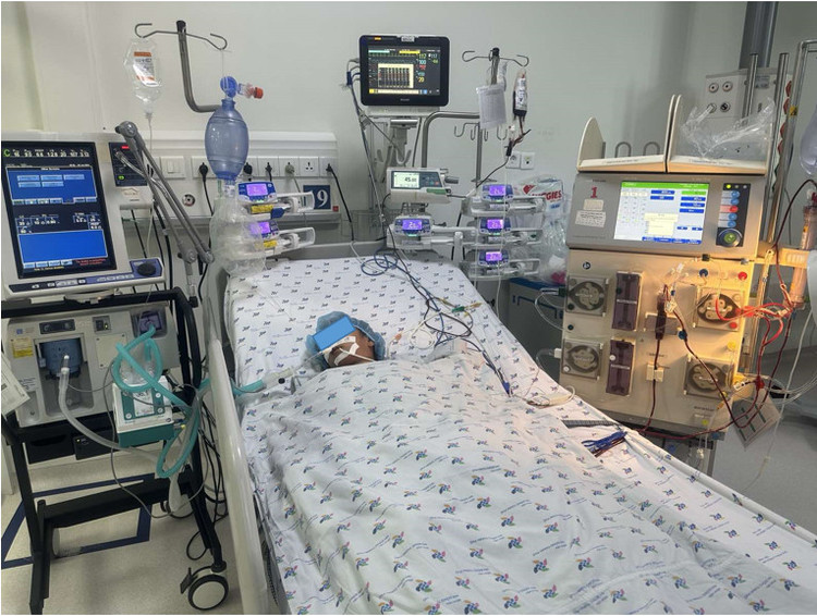 Bệnh nhi tổn thương đa cơ quan được thở máy, lọc máu liên tục sau khi bị bầy ong tấn công. Ảnh BVCC