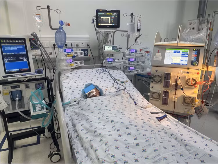 Bệnh nhi tổn thương đa cơ quan được thở máy, lọc máu liên tục sau khi bị bầy ong tấn công. Ảnh BVCC