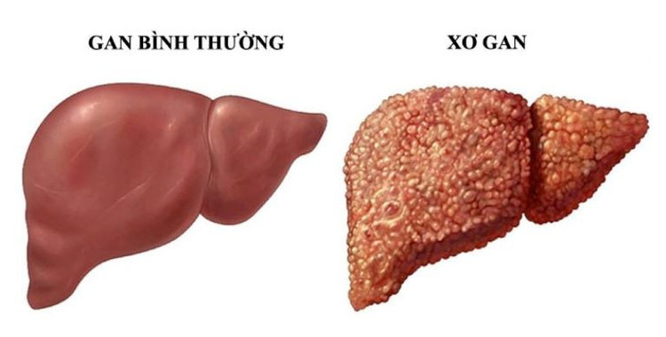 Triệu chứng cảnh báo xơ gan, cần lưu ý. Ảnh minh họa