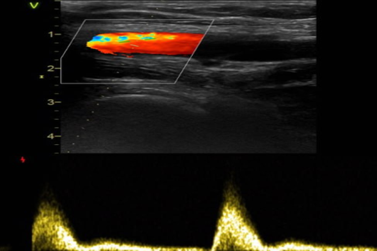 Hình ảnh siêu âm phát hiện tình trạng huyết khối tĩnh mạch chày sau hai bên. Ảnh BVCC