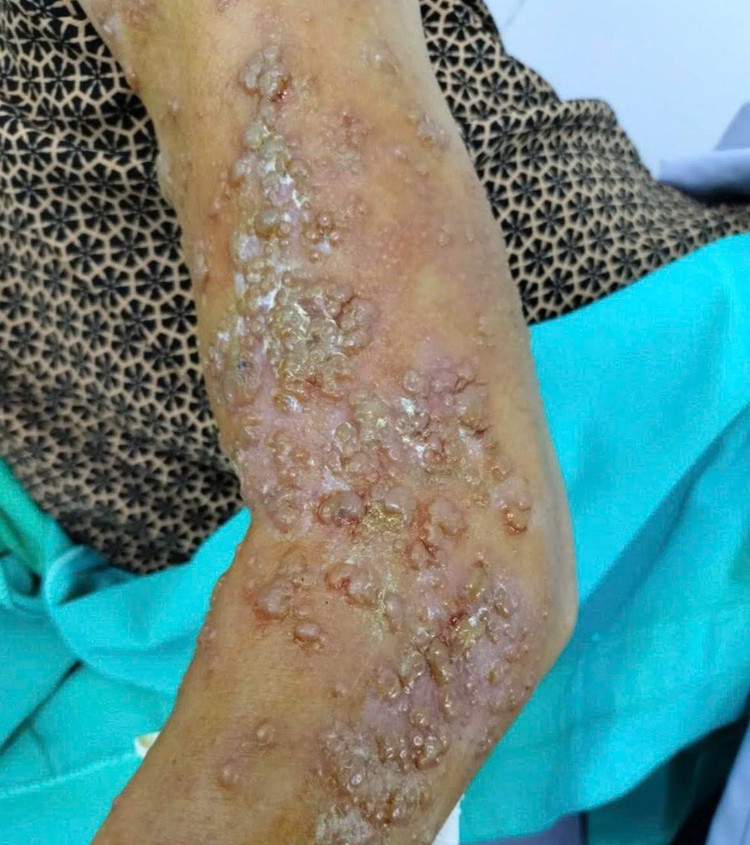 Cánh tay bị nổi mụn nước rải rác của bệnh nhân. Ảnh: Trung tâm Y tế huyện Tân Sơn.