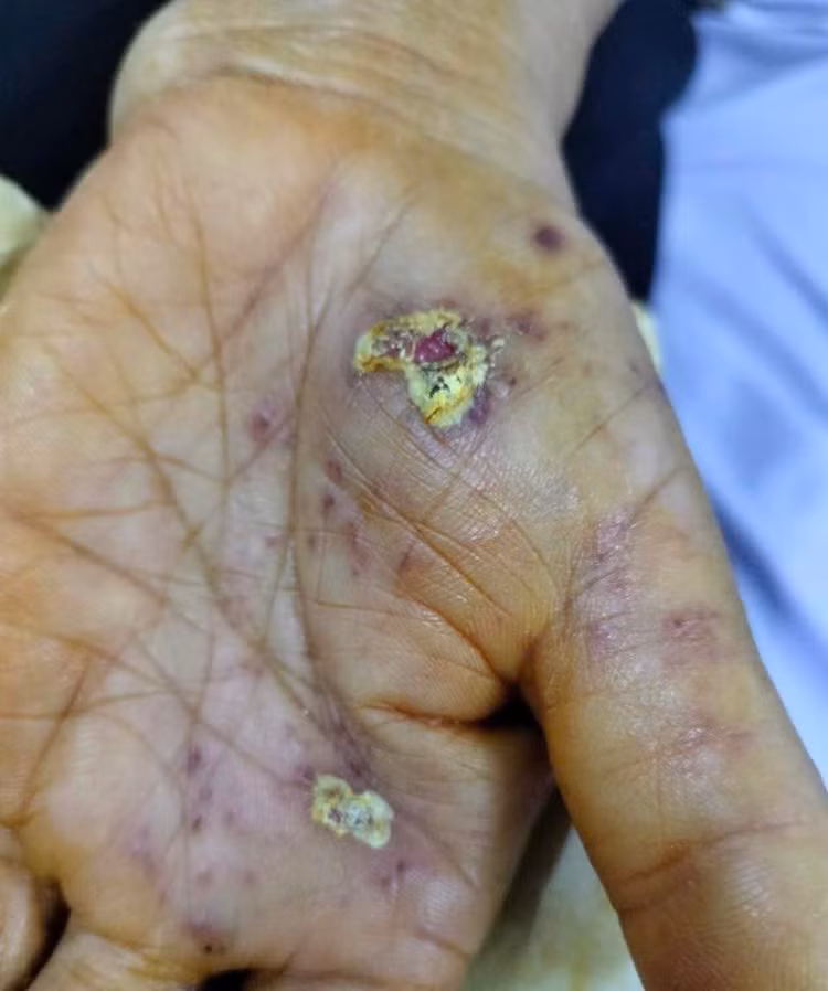 Bàn tay bị nổi mụn nước rải rác của bệnh nhân. Ảnh: Trung tâm Y tế huyện Tân Sơn.