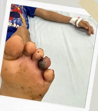 Bé trai 9 tuổi bị hoại tử ngón chân vì đắp thuốc nam chữa rắn cắn. Ảnh BVCC