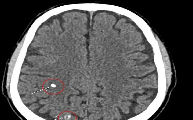 Đi khám bệnh tuyến giáp, người đàn ông 66 tuổi bất ngờ phát hiện sán não ảnh 1